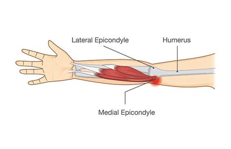 Understanding Tennis and Golfer's Elbow: Causes & Treatments ...