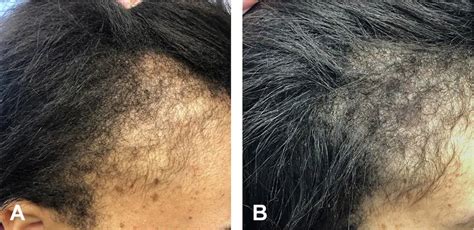 Minoxidil Results After 1 Year - Wimpole Clinic