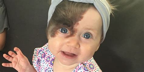 Baby With Birthmark on Right Side of Her Face - Ruby Ashby to Have Birthmark Removed