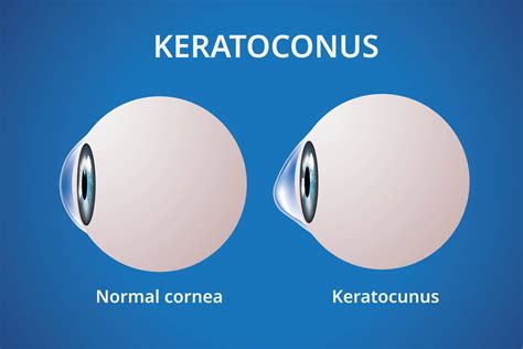 8 Keratoconus Treatments for Vision Loss