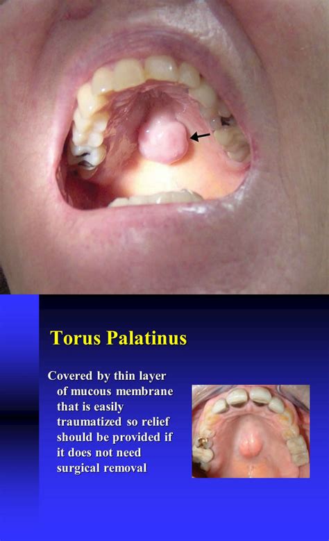 Torus Palatinus Removal