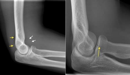 Radial head fracture - Radiology at St. Vincent's University Hospital