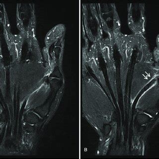 (PDF) Spontaneous rupture of flexor pollicis longus tendon by tendolipomatosis in proximal ...