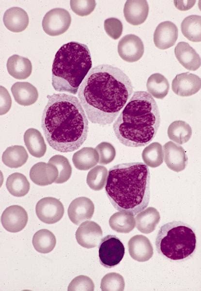 Pathology Outlines - Monocytes