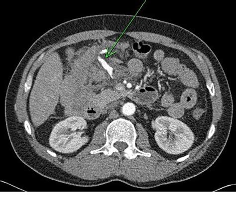 Figure 1 from Middle colic artery aneurysm: a case report and review of the literature ...