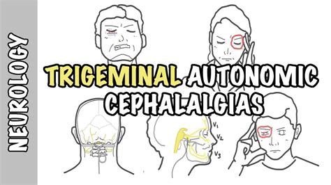 Severe headaches - Understanding Trigeminal Autonomic Cephalgias ...