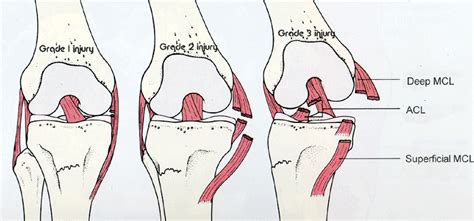 MCL Injury | Med-Health.net