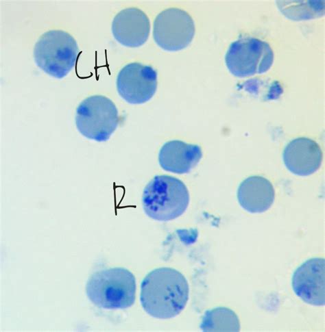 Reticulocyte New Methylene Blue