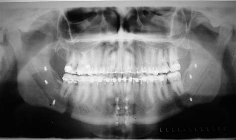 Genial Tubercle Advancement for Obstructive Sleep Apnea Syndrome: A ...