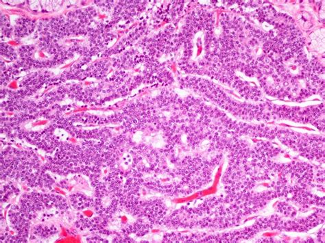 Pathology Outlines - Neuroendocrine neoplasms-general