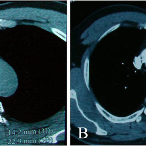 Computed tomography showed a tissue mass in the anterior mediastinum.... | Download Scientific ...