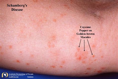 Schamberg's Disease: A Pigmentary Purpuric Eruption... - Academic Dermatology of Nevada