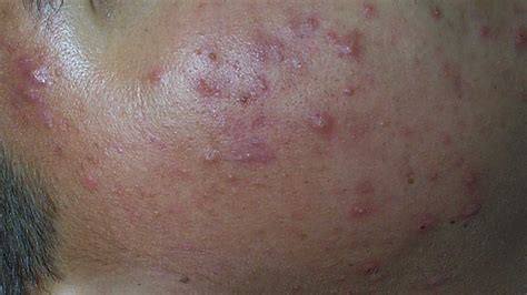 Where are acne nodules – Health News