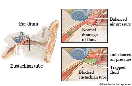 Eustachian Tube Dysfunction