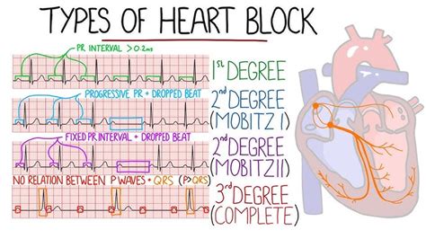 Third Degree Heart Block Animation