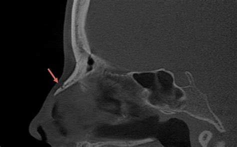 What is the Best Imaging Study to Evaluate a Broken Nose?