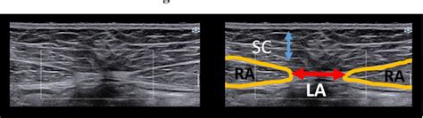 Figure 1 from Differences in Linea Alba Stiffness and Linea Alba Distortion Between Women With ...