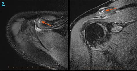 Mri Shoulder Dislocation