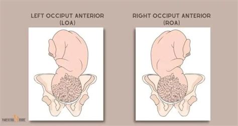 ROA Position-Benefits, Risks, How It Affects Labor & Delivery