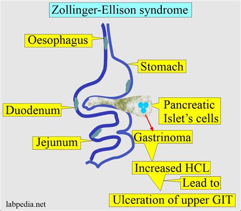 Zollinger-Ellison Syndrome: Video, Anatomy Definition, 45% OFF