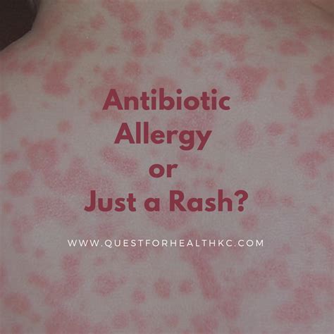 Antibiotic Allergy or Just a Rash? - Quest for Health KC | Rash allergy, Allergic reaction rash ...