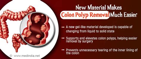 New Material Could Make Removal of Colon Polyps Much Easier: Here’s How