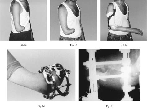 Figure 2 from Lengthening of congenital below-elbow amputation stumps by the Ilizarov technique ...