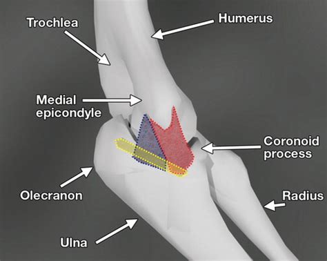 Traumatic Elbow Injuries: What the Orthopedic Surgeon Wants to Know | RadioGraphics