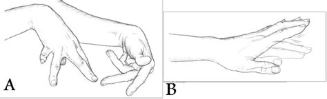 Doctors Gates: How to distinguish Athetosis from Chorea