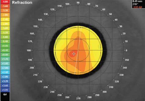 Multifocal IOLs: What Have We Learned? | CollaborativeEYE