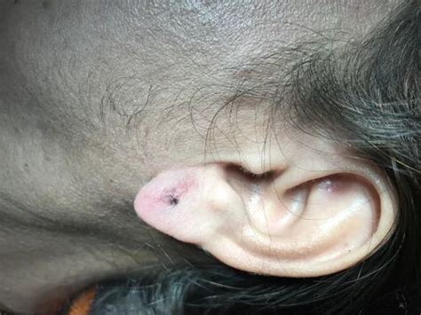 Ear Piercing After Split Ear Lobule Repair in Nagpur | ID: 14456761697