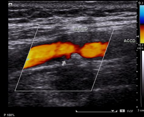 Doppler Ultrasound Scan Of Carotid Artery Stenosis Photograph By Fine | My XXX Hot Girl