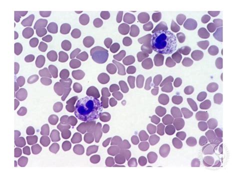 Chronic Neutrophilic Leukemia