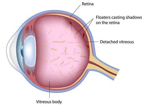 Laser Vitreolysis - Denver, CO - Hines Sight - Laser Floater Removal