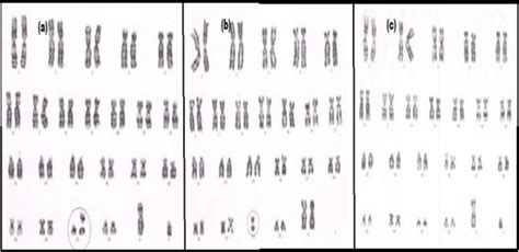 Translocation Down Syndrome Karyotype