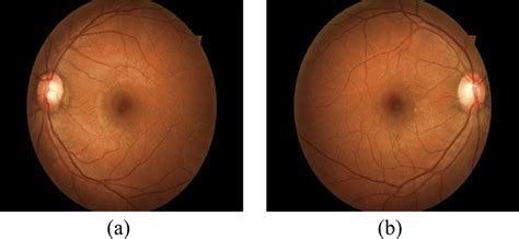 (a) Right eye fundus; (b) Left eye fundus. | Download Scientific Diagram