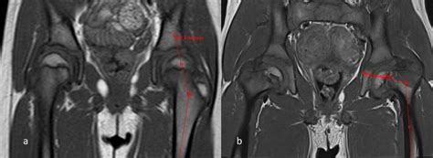 a) Bilateral coxa valga b) bilateral coxa vara appearances in two... | Download Scientific Diagram