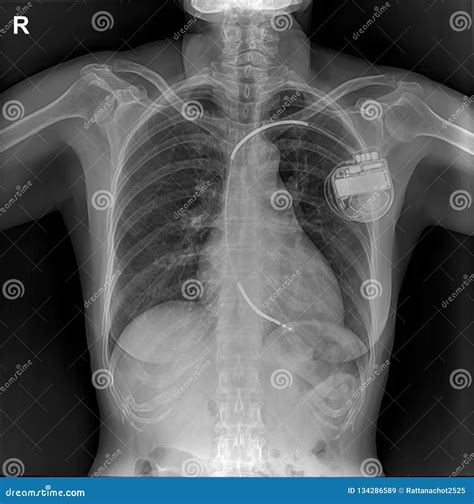 Pacemaker Showing in Chest X-ray Stock Image - Image of artificial, film: 134286589