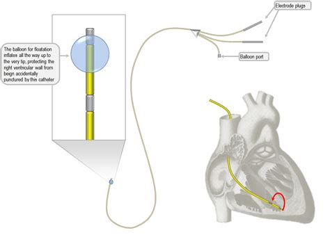 Anatomy of the temporary pacemaker circuit | Deranged Physiology