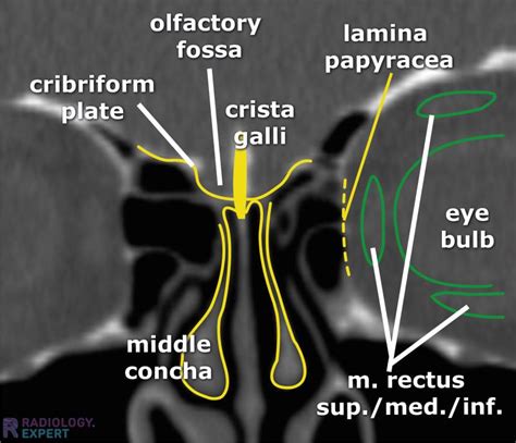 CT sinus