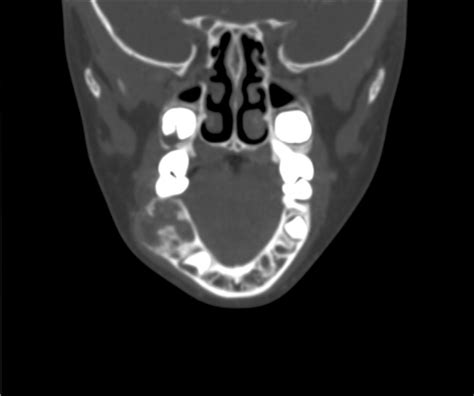 A CT scan of the mandible of the patient. Imaging shows a mass on the ...