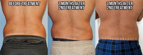 Coolsculpting Experience: Lower Belly & Love Handles | Slashed Beauty