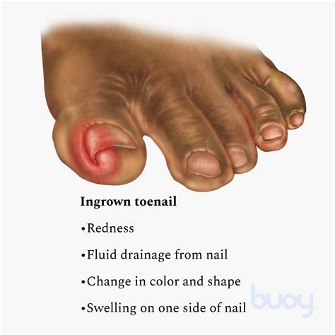 How To Drain Pus From Ingrown Toenail - Best Drain Photos Primagem.Org