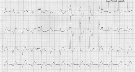 Accelerated Idioventricular Rhythm Treatment - Quotes Update