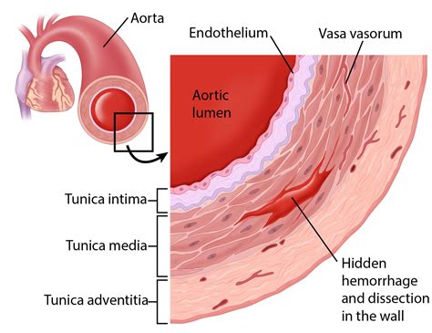 Aortic Dissection