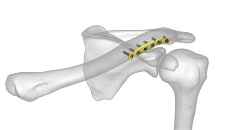 Anterior Clavicle Plate | Acumed