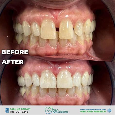 Composite Veneers - Dentist in Miami, FL | The Smile Mission