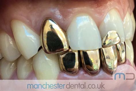 Gold Teeth / Gold Crowns - Manchester Dental