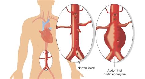 Fenestrated endovascular aneurysm repair - Norton Healthcare Provider Louisville, Ky.