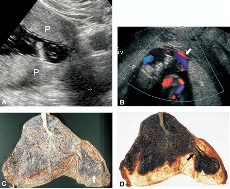 Succenturiate lobe. (A) Grayscale image shows placental tissue (P) on... | Download Scientific ...